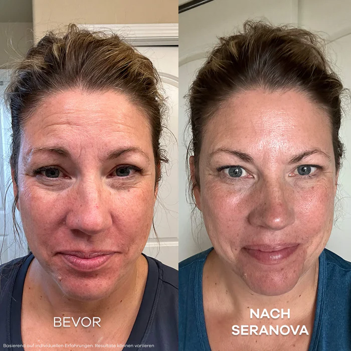 Seranova Micro Infusion Kaufen